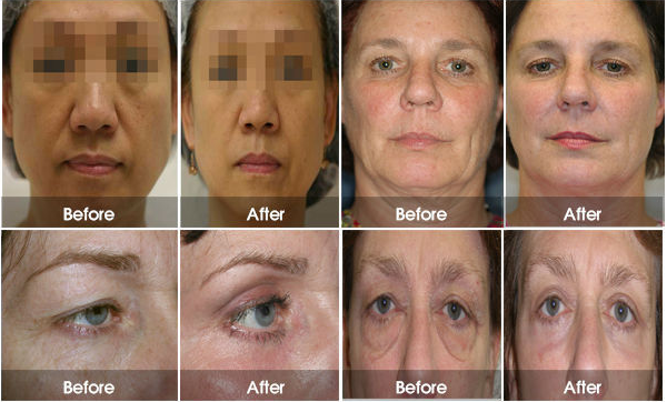 Máy trẻ hóa da HIFU ODI H6  Máy trẻ hóa da HIFU ODI H6 .png (298 KB)